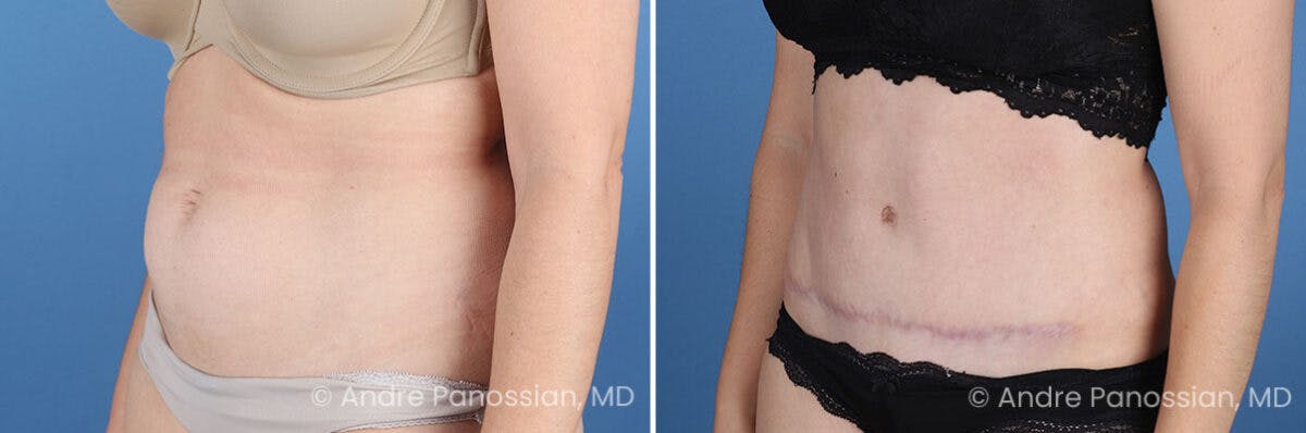 Tummy Tuck Before & After Gallery - Patient 240231 - Image 5