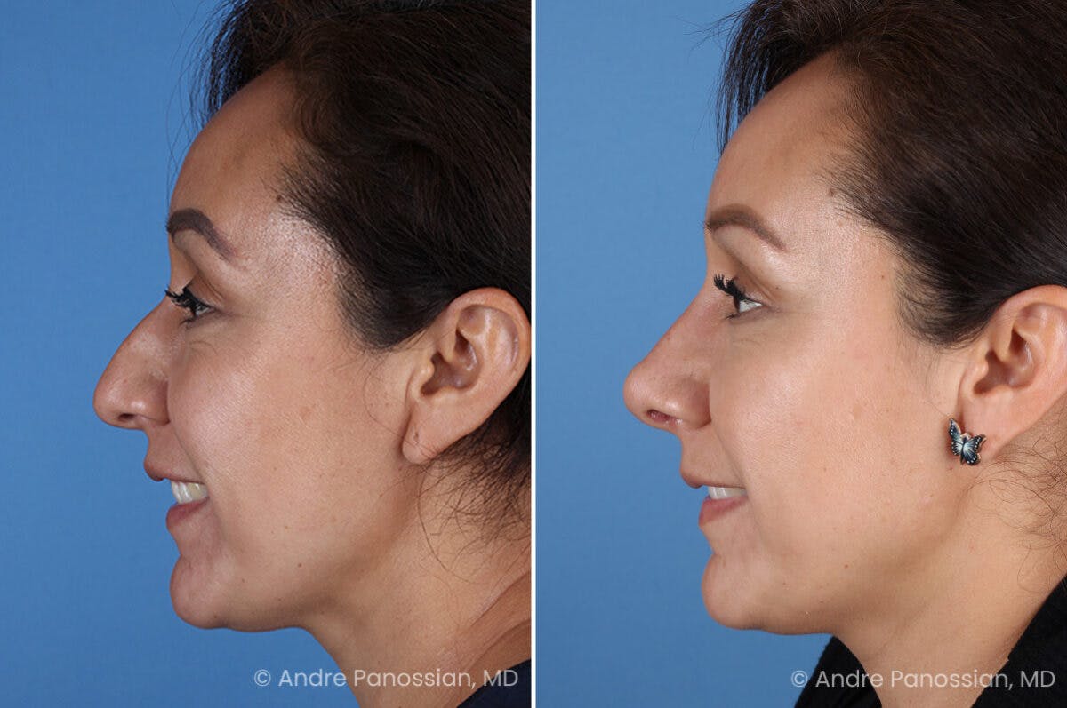 Rhinoplasty Before & After Gallery - Patient 401519 - Image 7