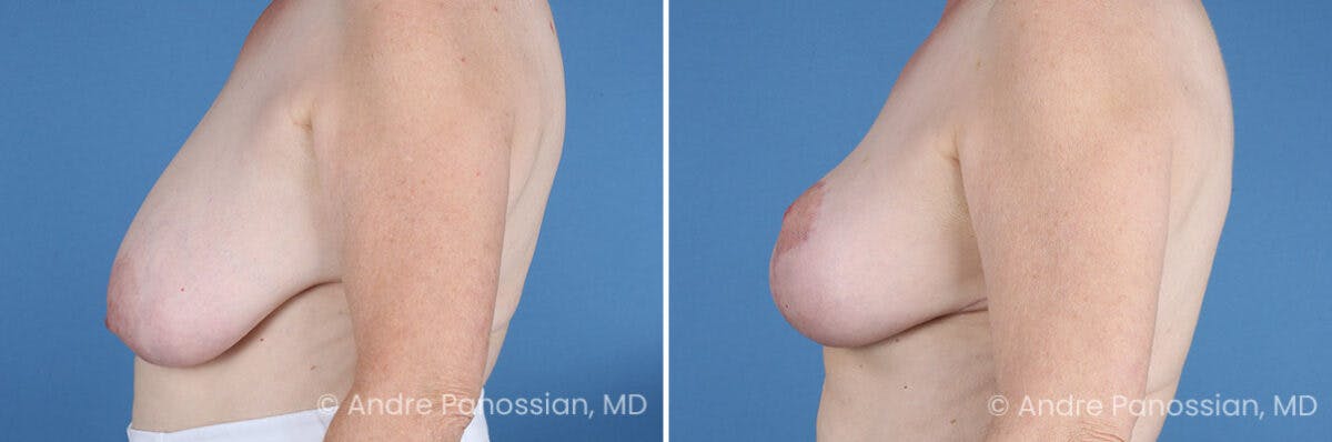 Breast Lift/Reduction Before & After Gallery - Patient 128292 - Image 5