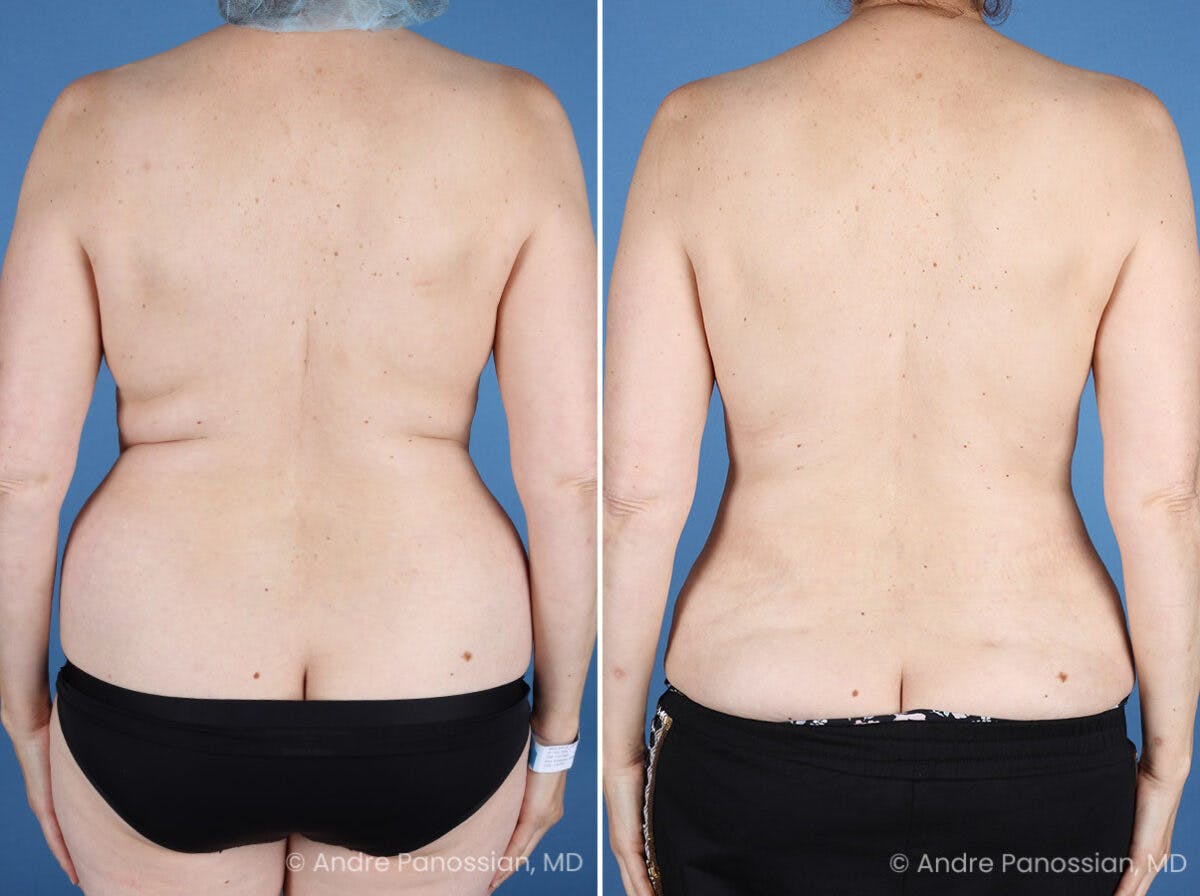 Mommy Makeover Before & After Gallery - Patient 739873 - Image 6