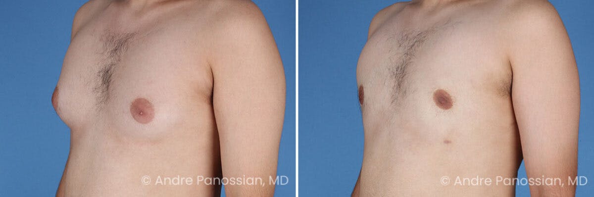 Male Breast Reduction (Gynecomastia) Before & After Gallery - Patient 351347 - Image 4
