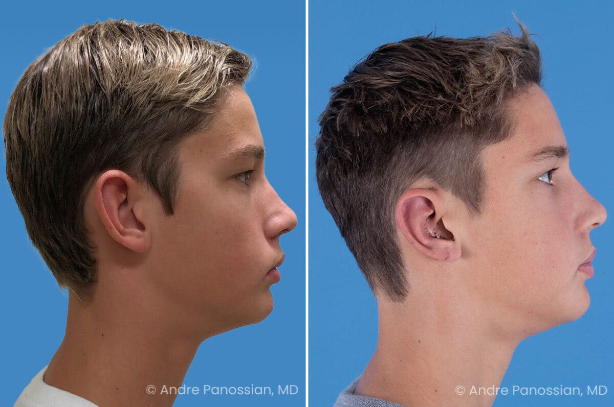 Ear Pinning (Otoplasty) Before & After Gallery - Patient 100215 - Image 3