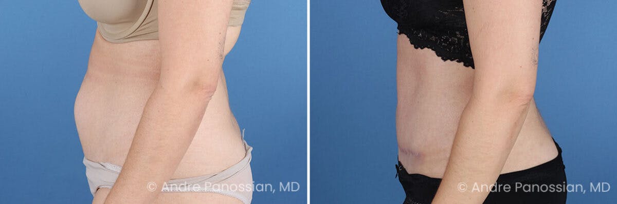 Tummy Tuck Before & After Gallery - Patient 240231 - Image 6