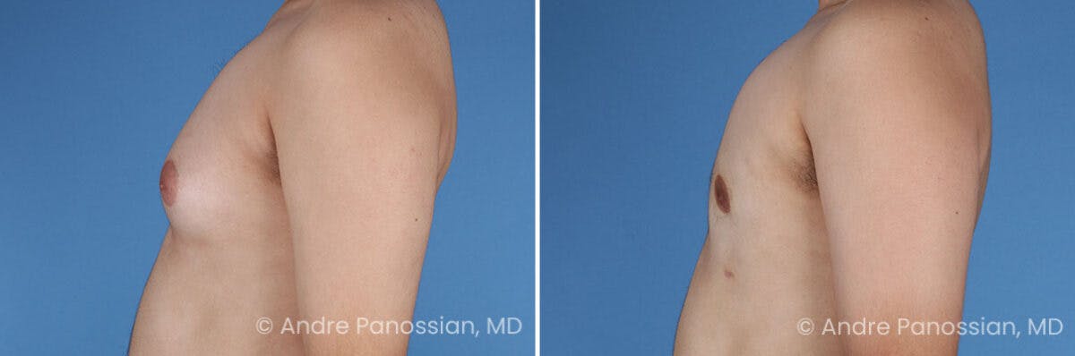 Male Breast Reduction (Gynecomastia) Before & After Gallery - Patient 351347 - Image 5