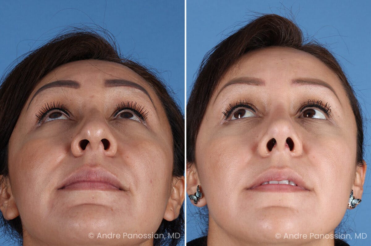 Rhinoplasty Before & After Gallery - Patient 401519 - Image 8