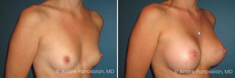 Breast Augmentation Before & After Gallery - Patient 143353 - Image 1
