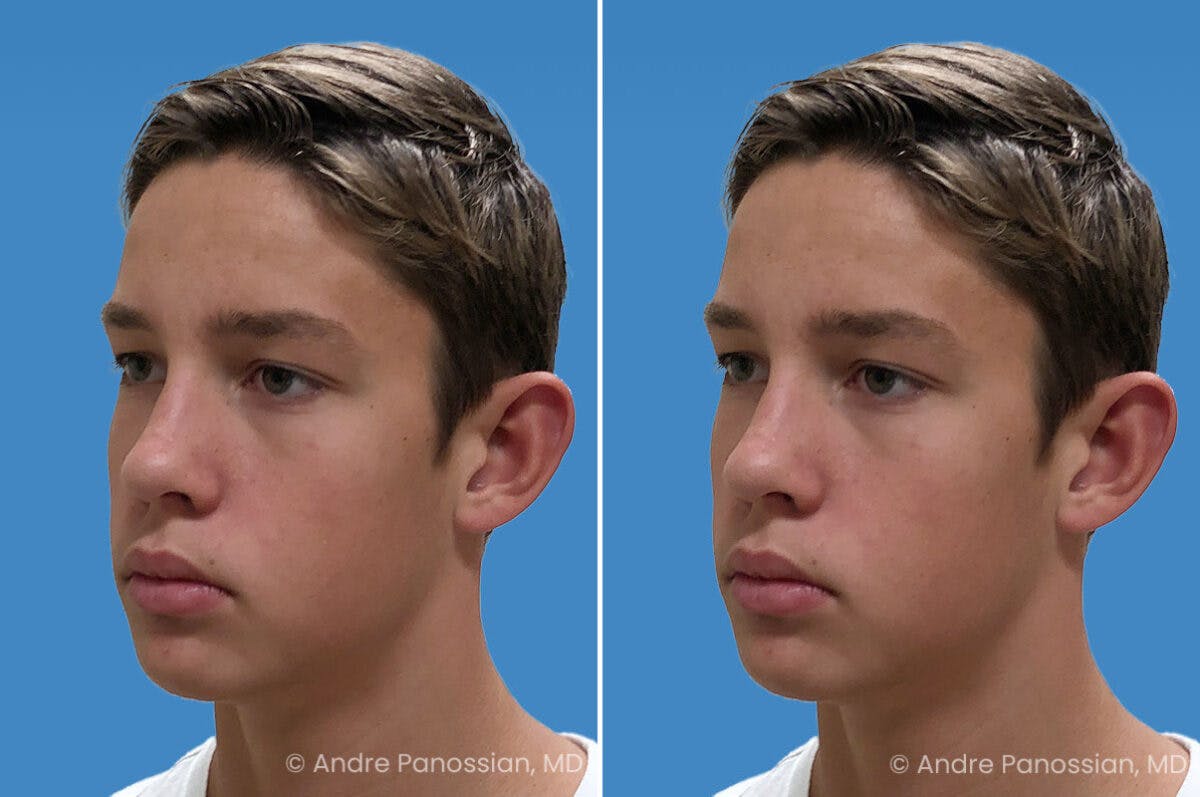 Ear Pinning (Otoplasty) Before & After Gallery - Patient 100215 - Image 4