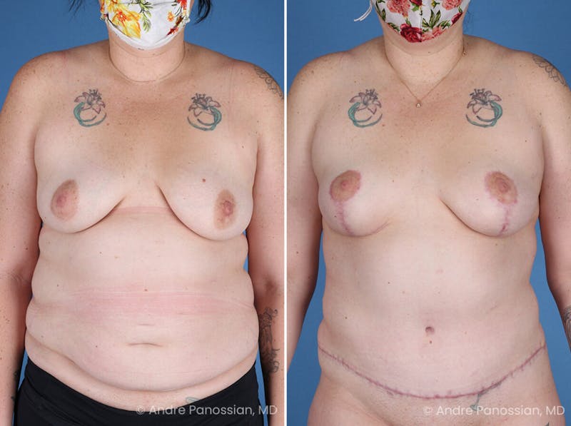Mommy Makeover Before & After Gallery - Patient 197015 - Image 1