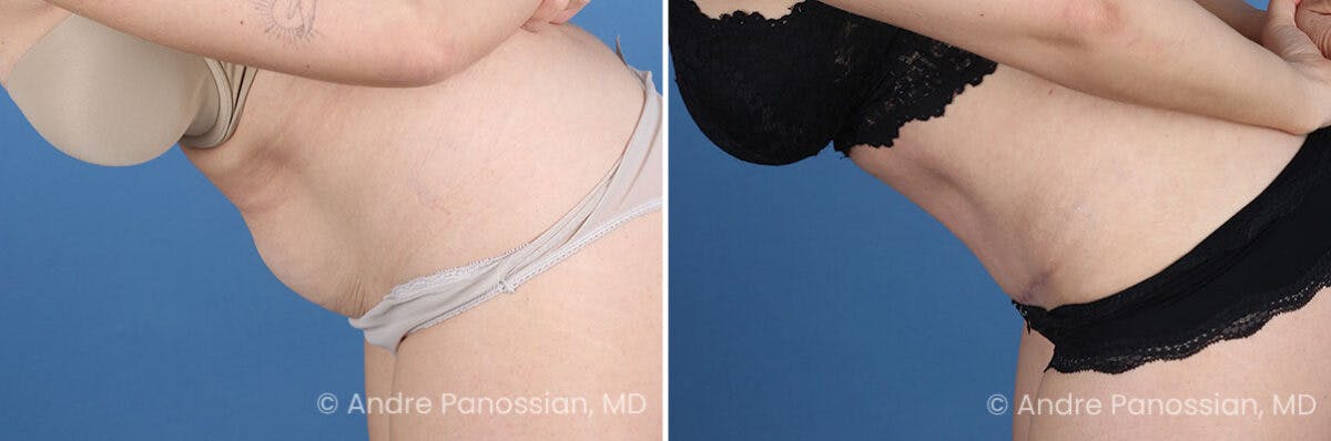 Tummy Tuck Before & After Gallery - Patient 240231 - Image 7