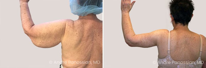 Upper Arm Lift Before & After Gallery - Patient 550201 - Image 1