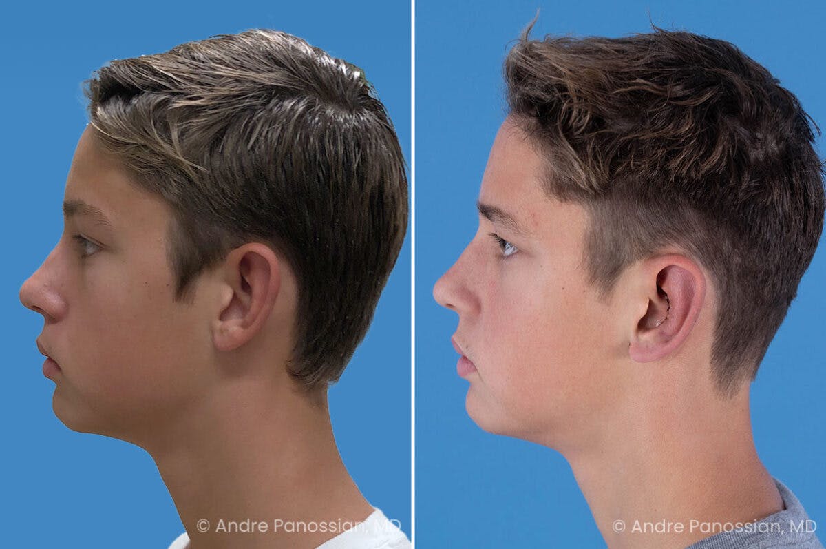 Ear Pinning (Otoplasty) Before & After Gallery - Patient 100215 - Image 5