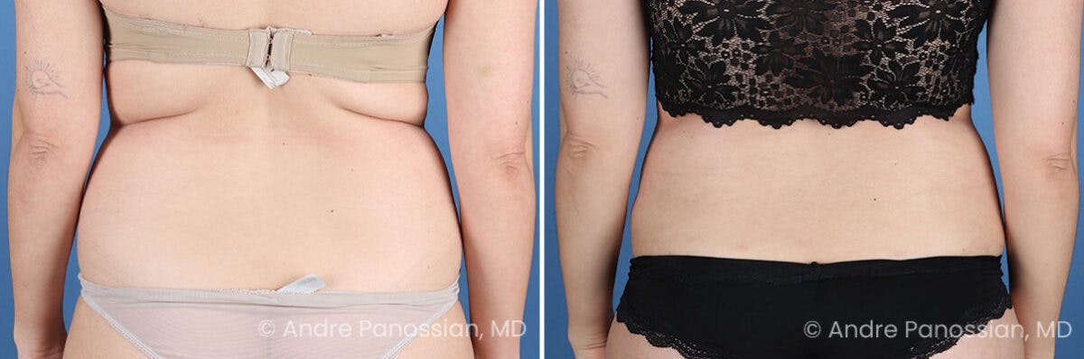 Tummy Tuck Before & After Gallery - Patient 240231 - Image 8