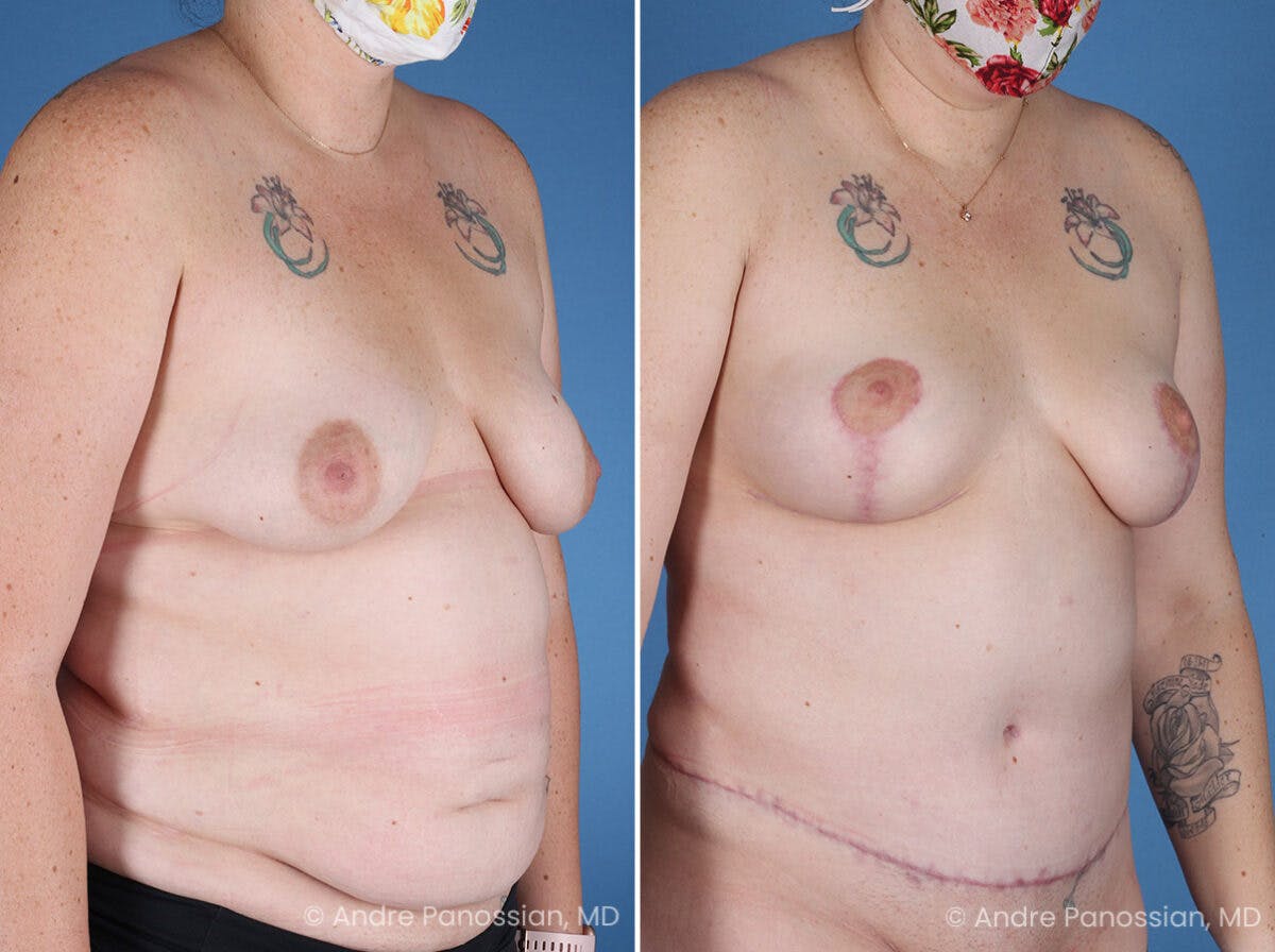 Mommy Makeover Before & After Gallery - Patient 197015 - Image 2