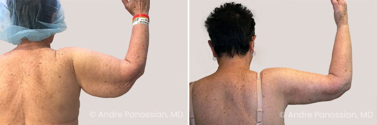 Upper Arm Lift Before & After Gallery - Patient 550201 - Image 2