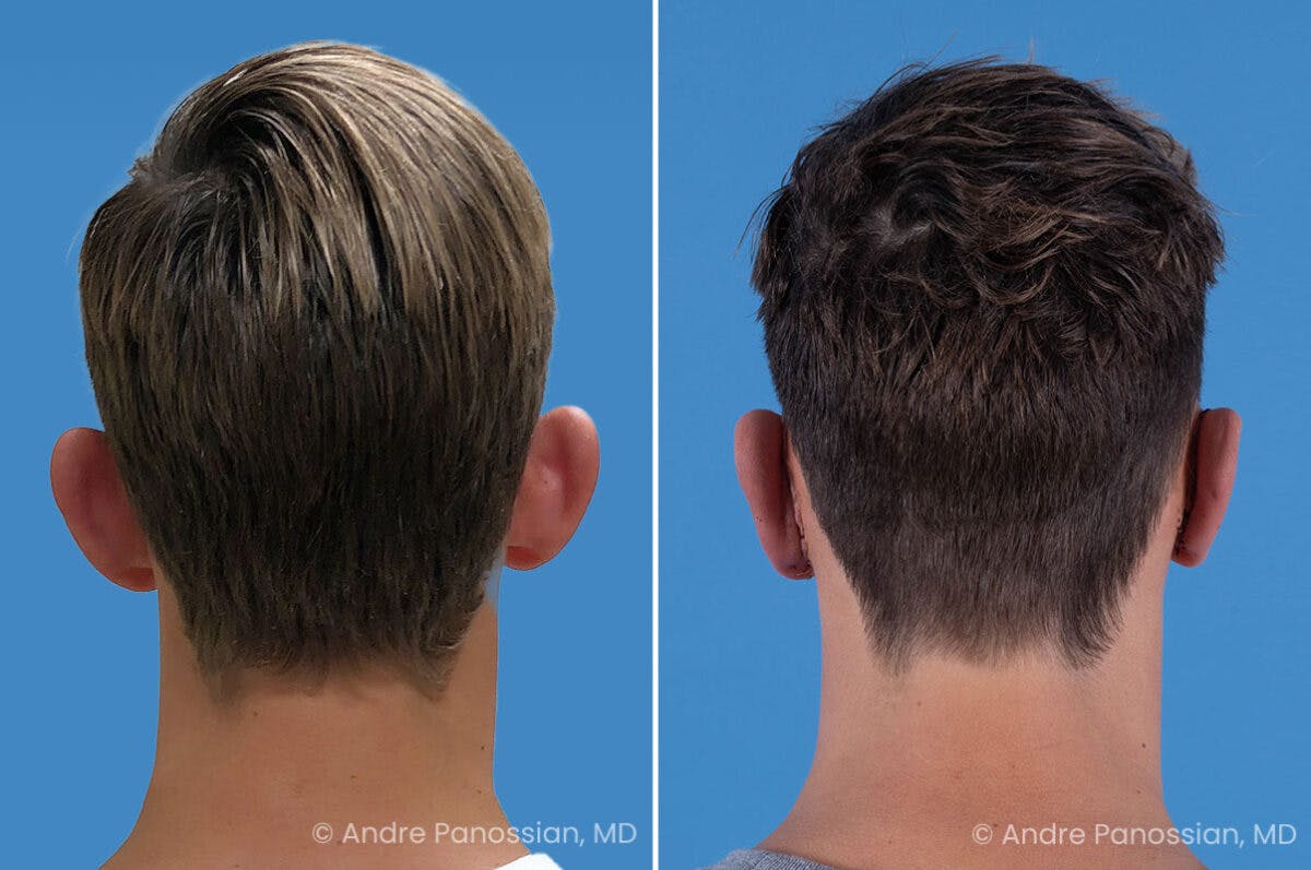 Ear Pinning (Otoplasty) Before & After Gallery - Patient 100215 - Image 6