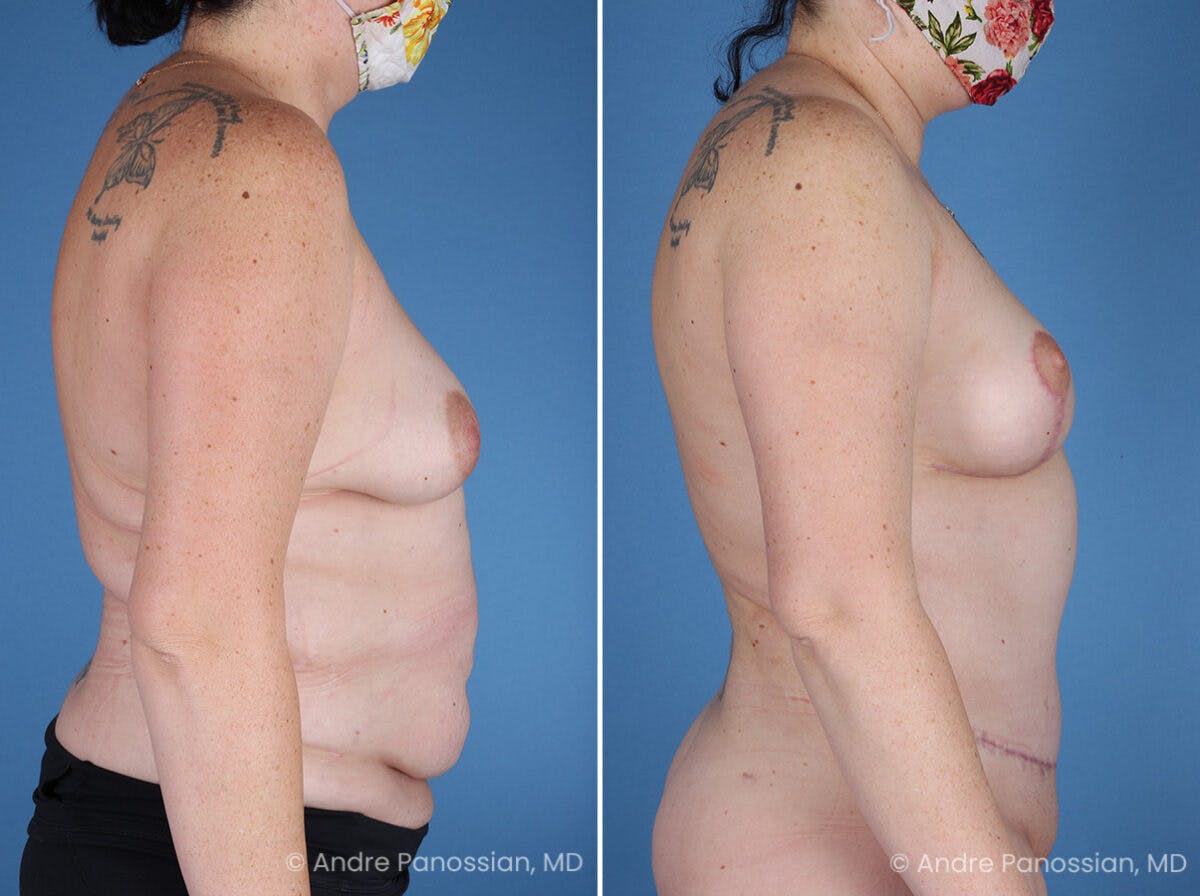 Mommy Makeover Before & After Gallery - Patient 197015 - Image 3