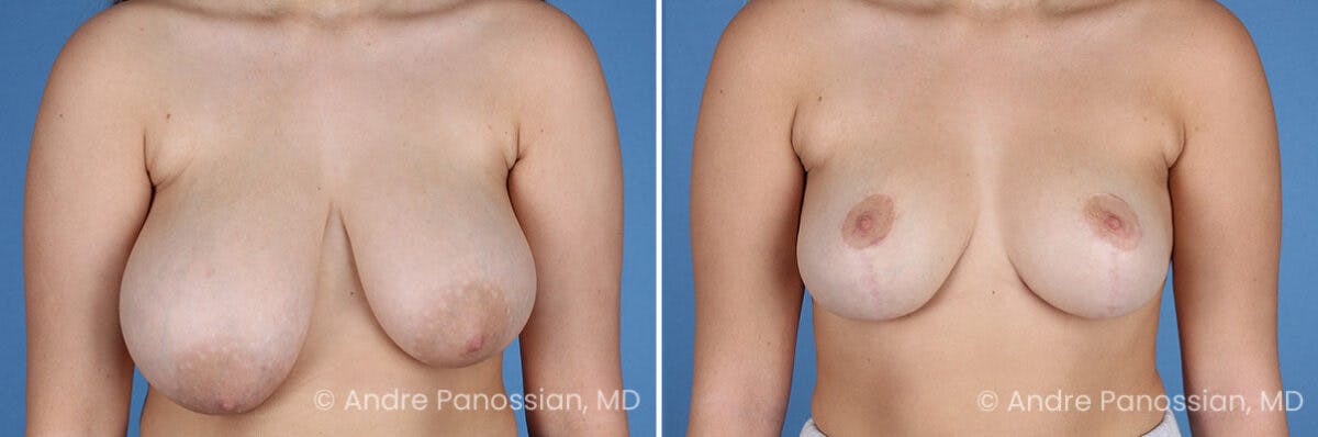 Breast Lift/Reduction Before & After Gallery - Patient 395640 - Image 1