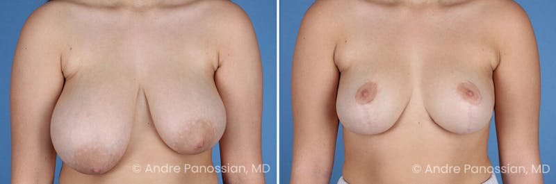 Breast Lift/Reduction Before & After Gallery - Patient 395640 - Image 1