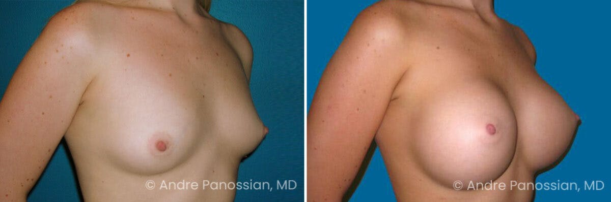 Breast Augmentation Before & After Gallery - Patient 935797 - Image 1