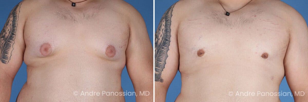 Male Breast Reduction (Gynecomastia) Before & After Gallery - Patient 419668 - Image 1