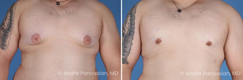 Male Breast Reduction (Gynecomastia) Before & After Gallery - Patient 419668 - Image 1