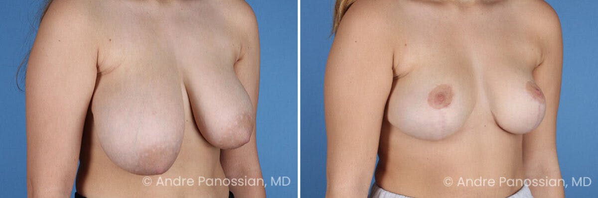 Breast Lift/Reduction Before & After Gallery - Patient 395640 - Image 2