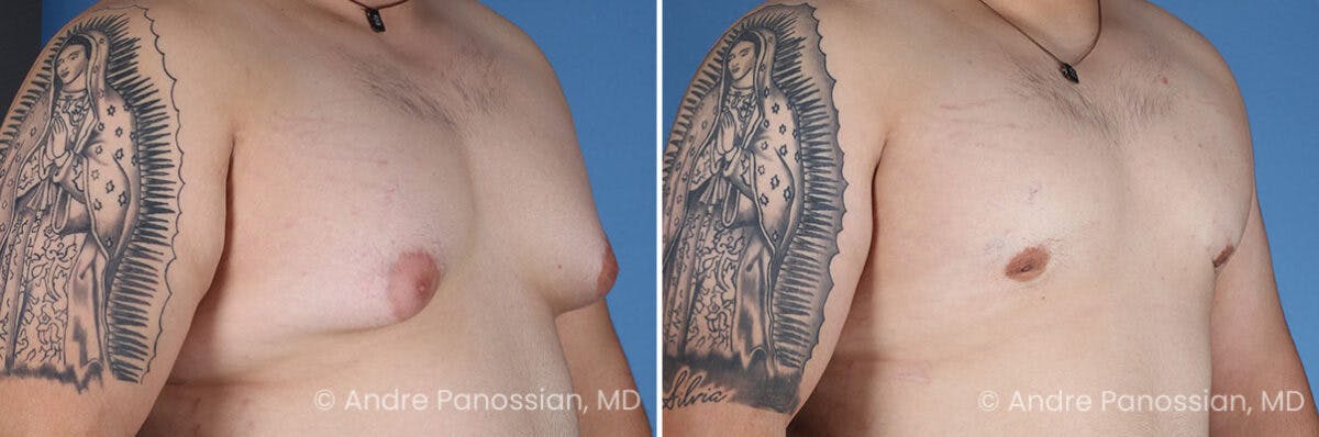 Male Breast Reduction (Gynecomastia) Before & After Gallery - Patient 419668 - Image 2
