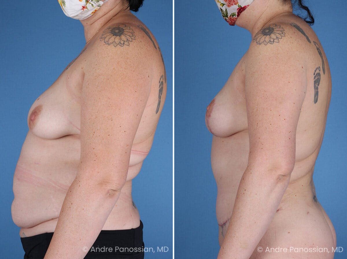 Mommy Makeover Before & After Gallery - Patient 197015 - Image 5