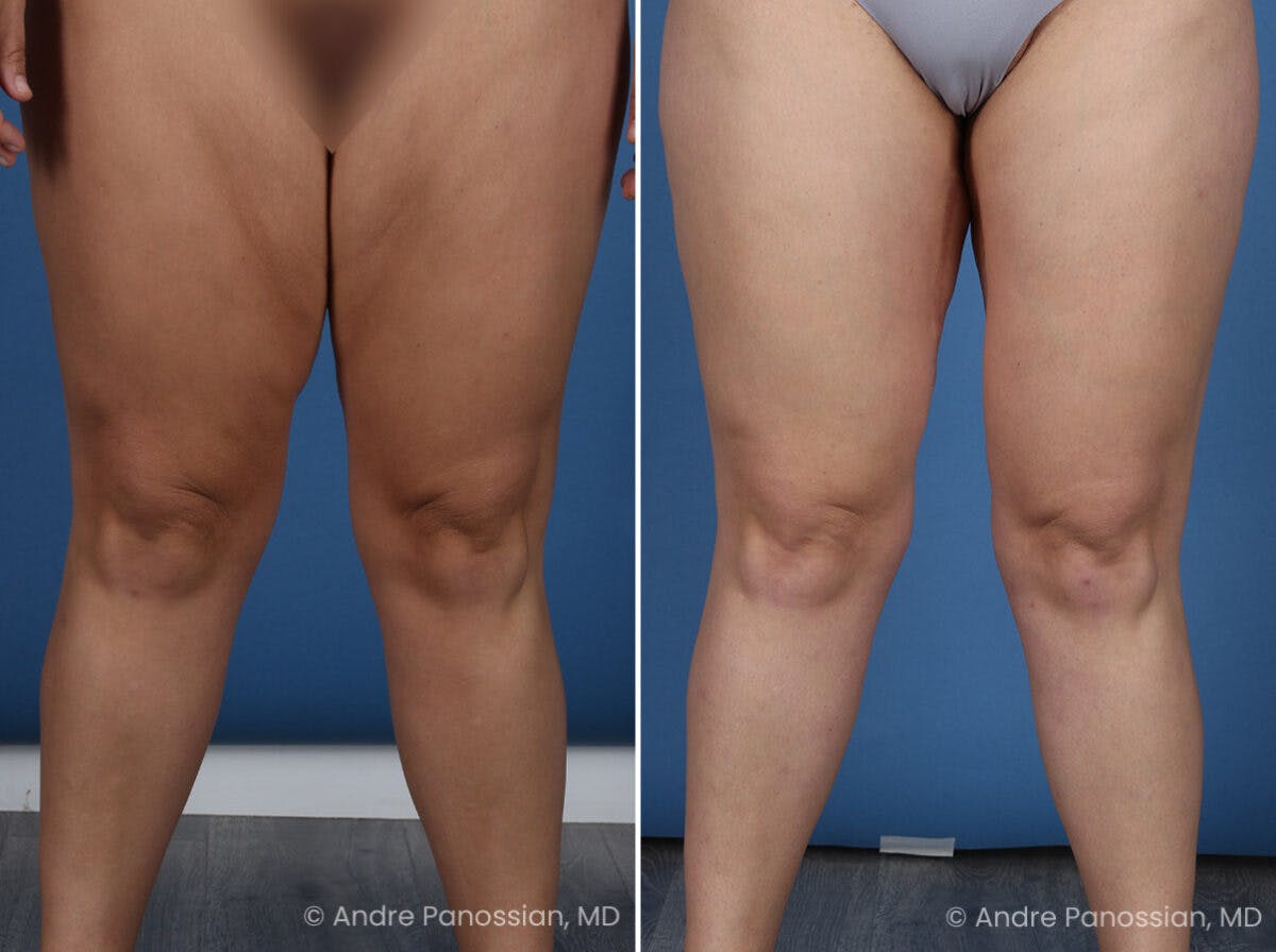 Thighplasty Before & After Gallery - Patient 277458 - Image 1