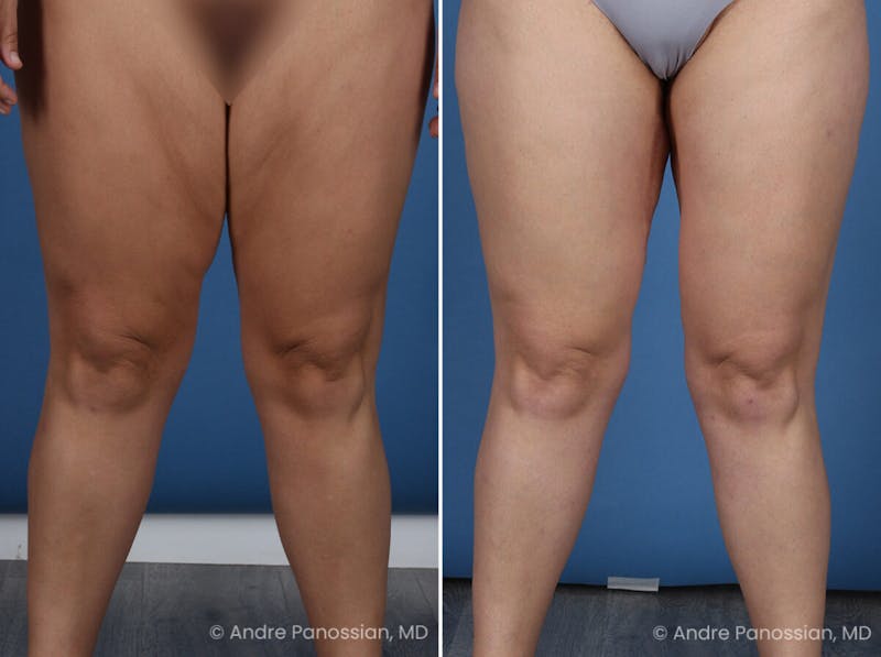 Thighplasty Before & After Gallery - Patient 277458 - Image 1