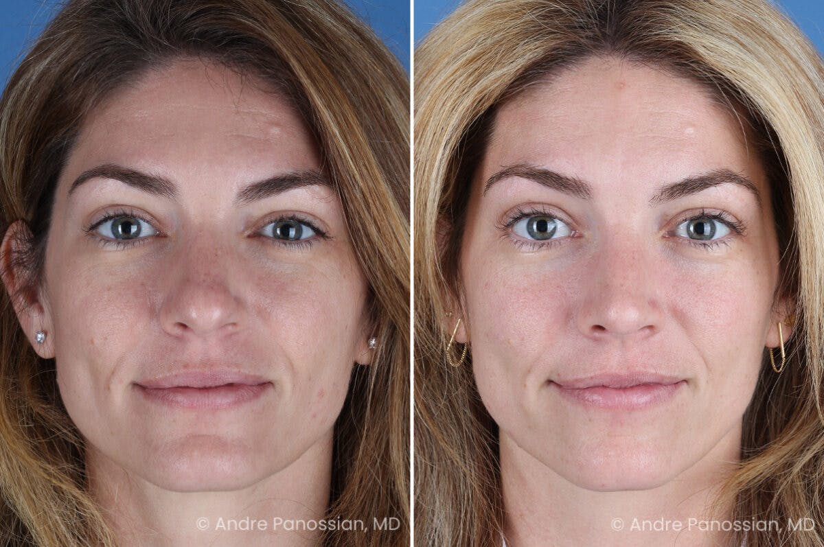 Rhinoplasty Before & After Gallery - Patient 303679 - Image 2