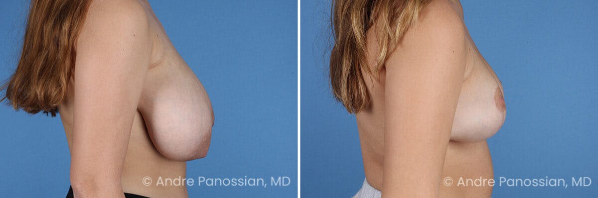 Breast Lift/Reduction Before & After Gallery - Patient 395640 - Image 3