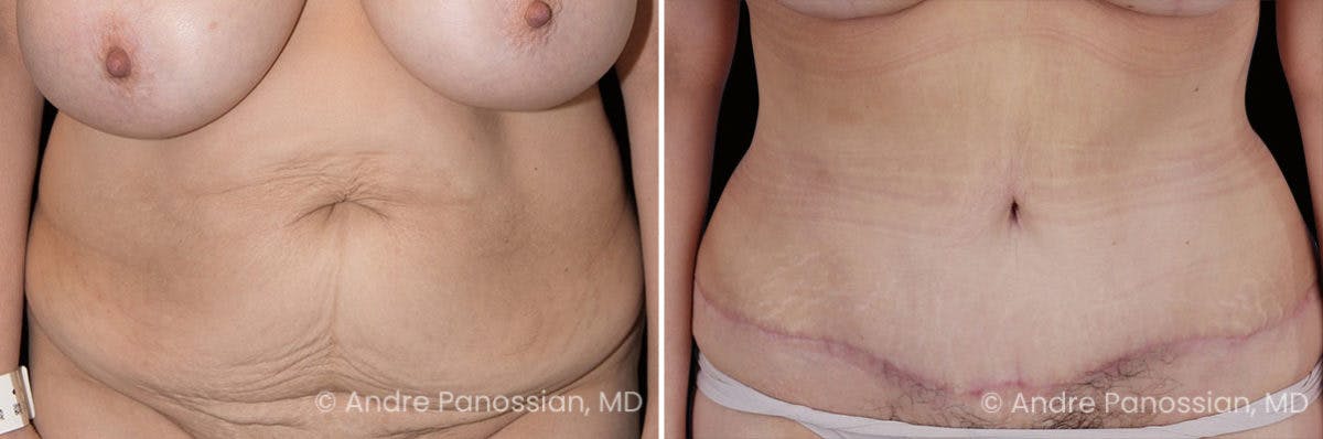 Tummy Tuck Before & After Gallery - Patient 220086 - Image 1