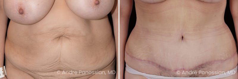 Tummy Tuck Before & After Gallery - Patient 220086 - Image 1