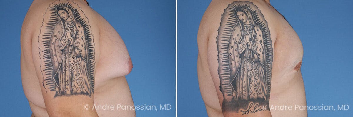 Male Breast Reduction (Gynecomastia) Before & After Gallery - Patient 419668 - Image 3