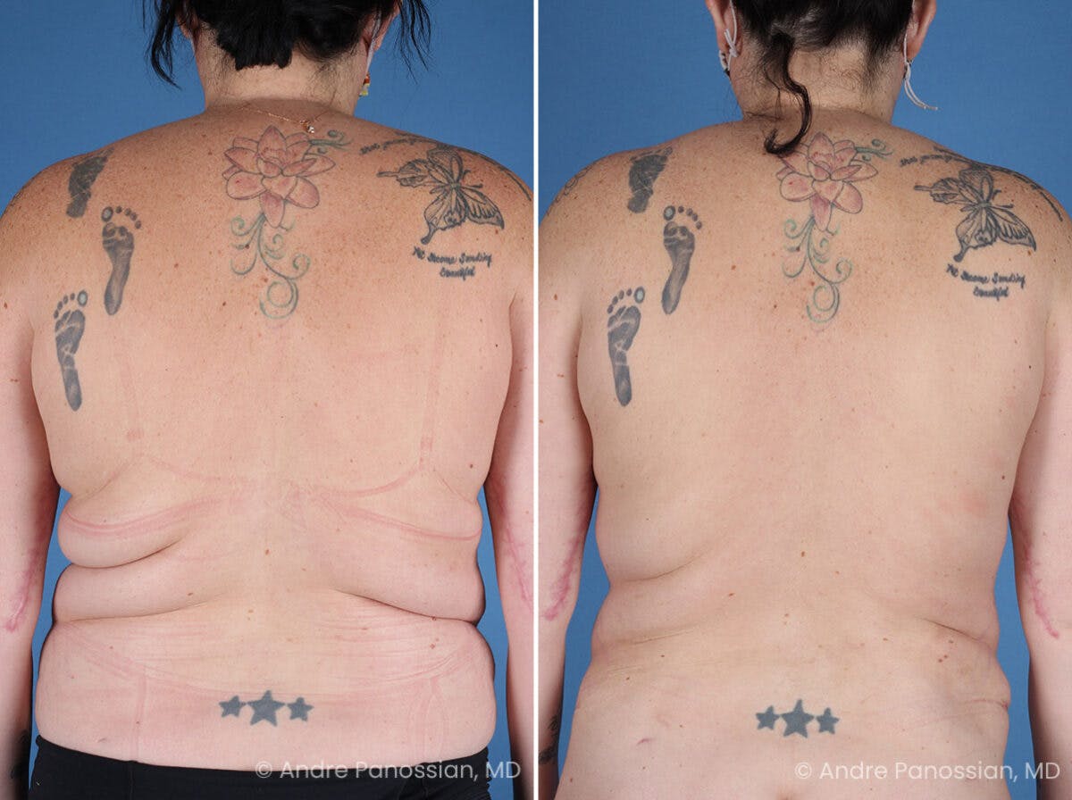 Mommy Makeover Before & After Gallery - Patient 197015 - Image 6