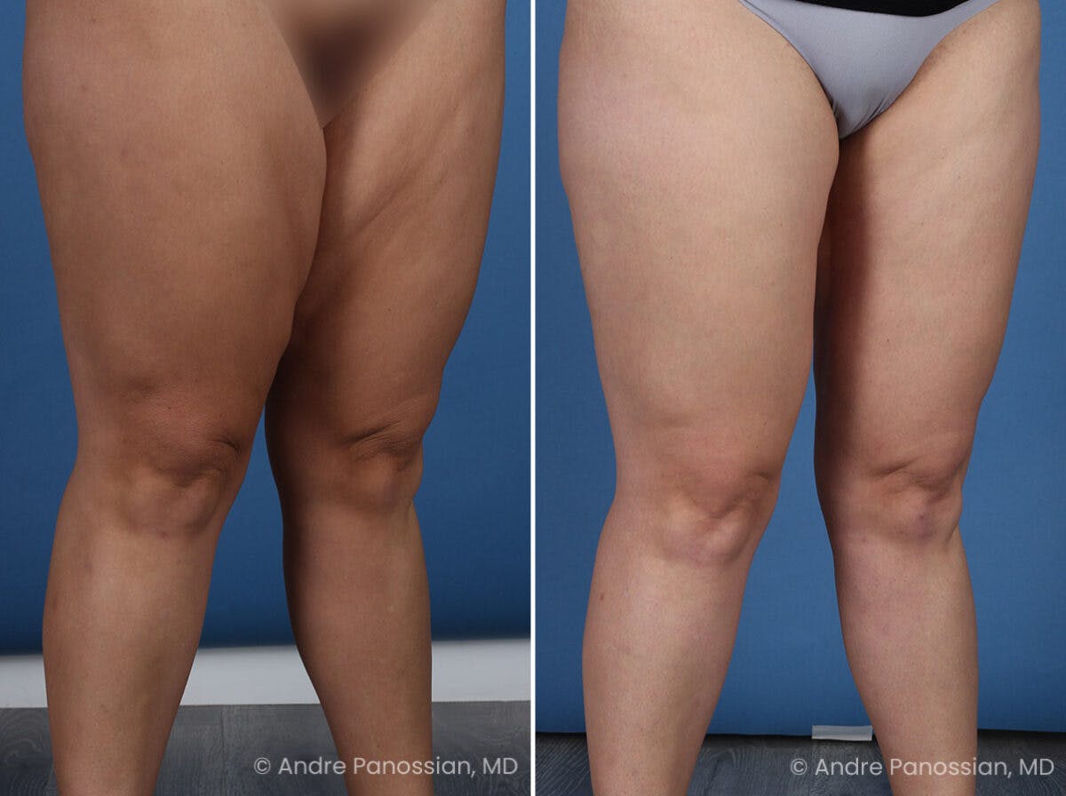 Thighplasty Before & After Gallery - Patient 277458 - Image 2