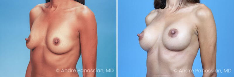 Breast Augmentation Before & After Gallery - Patient 294757 - Image 1