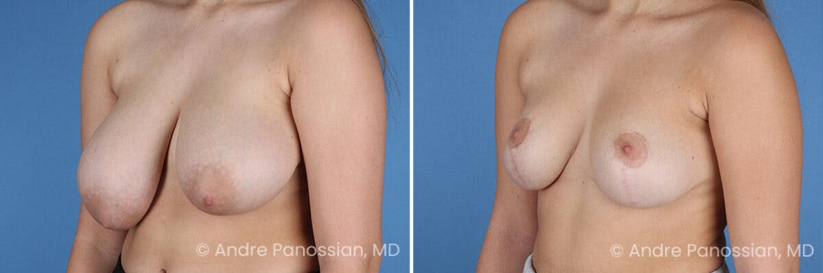 Breast Lift/Reduction Before & After Gallery - Patient 395640 - Image 4