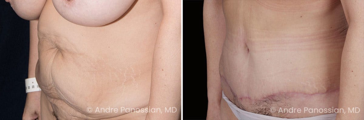 Tummy Tuck Before & After Gallery - Patient 220086 - Image 2