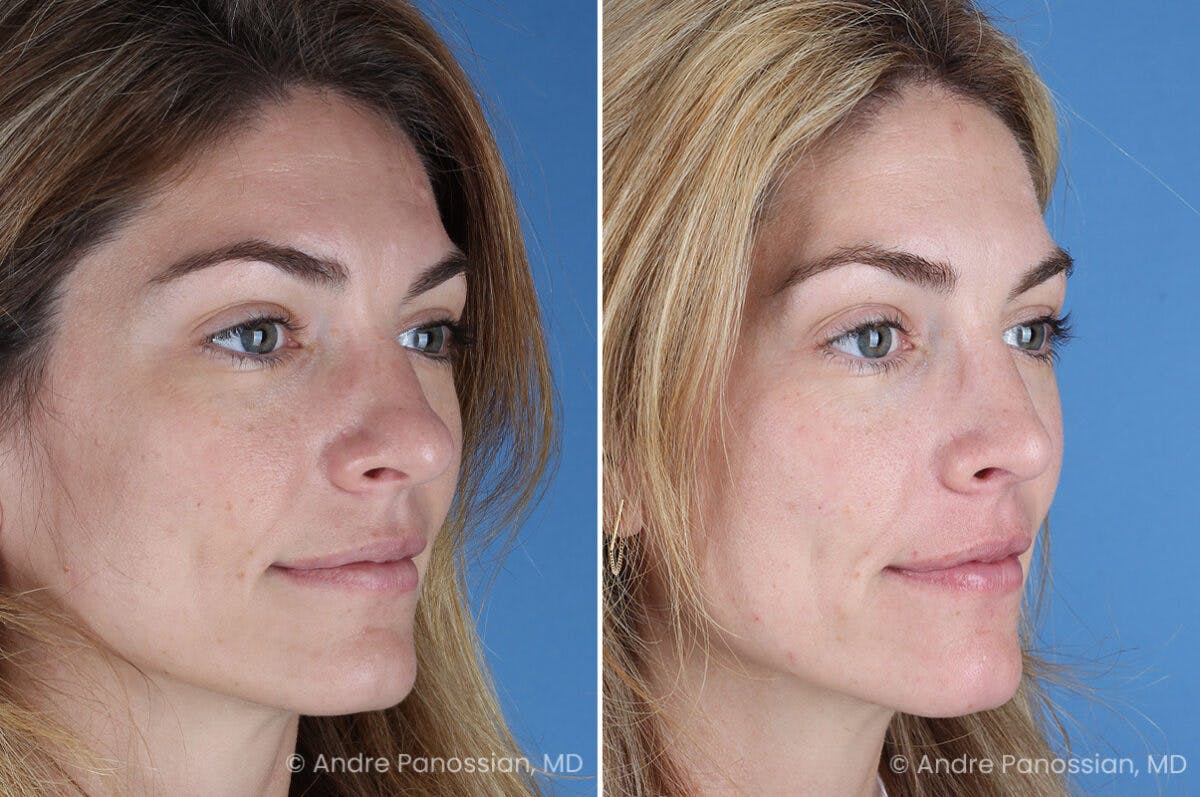 Rhinoplasty Before & After Gallery - Patient 303679 - Image 3