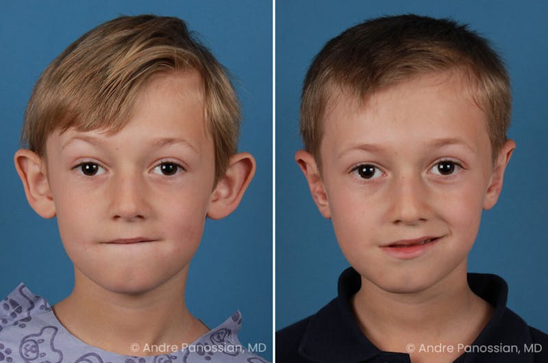 Ear Pinning (Otoplasty) Before & After Gallery - Patient 218645 - Image 1