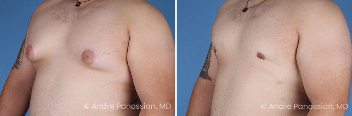Male Breast Reduction (Gynecomastia) Before & After Gallery - Patient 419668 - Image 4