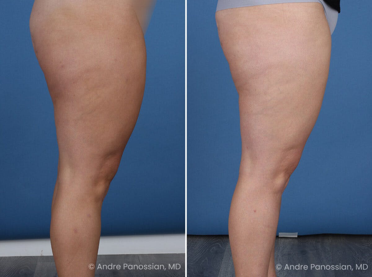 Thighplasty Before & After Gallery - Patient 277458 - Image 3