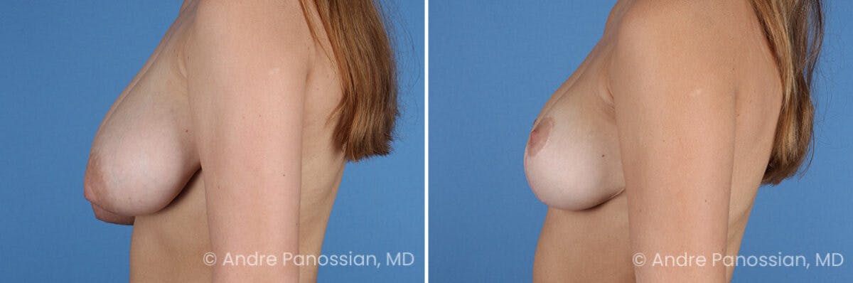 Breast Lift/Reduction Before & After Gallery - Patient 395640 - Image 5