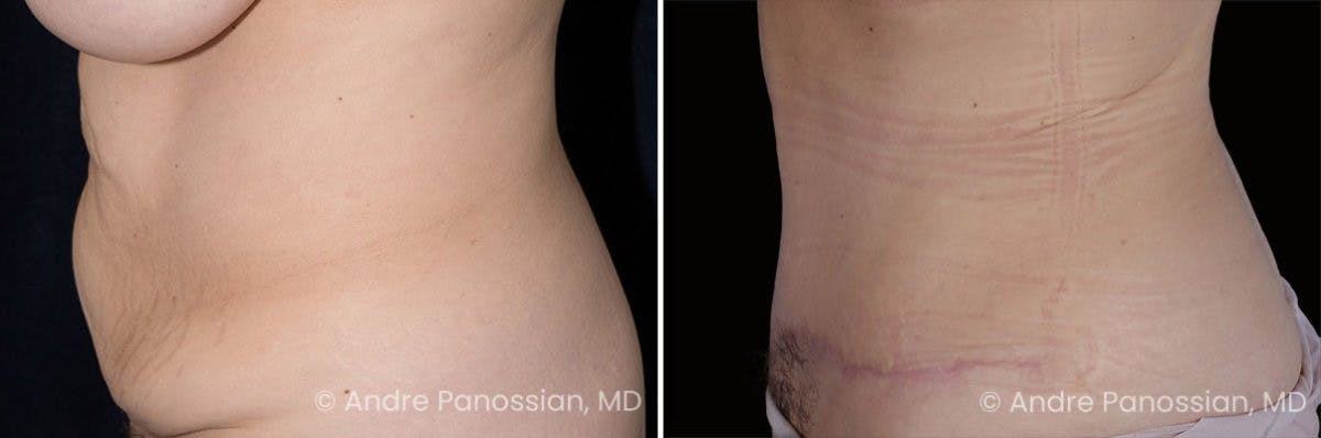 Tummy Tuck Before & After Gallery - Patient 220086 - Image 3