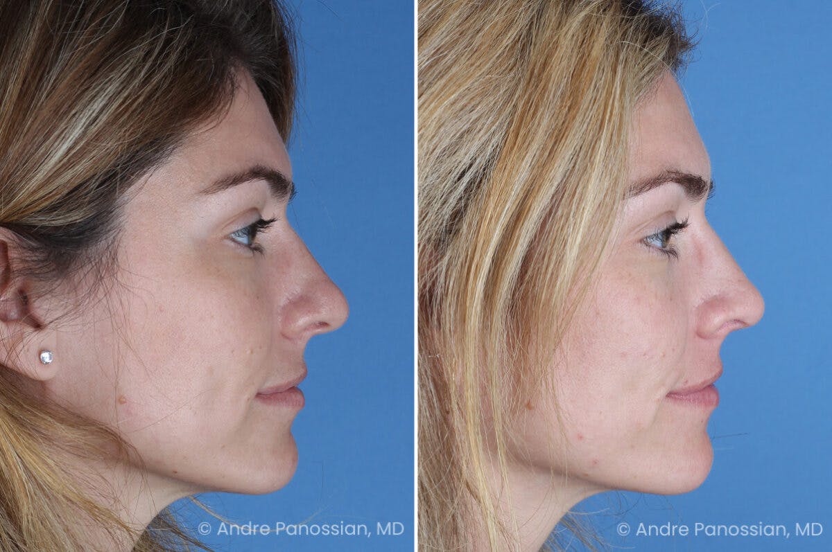 Rhinoplasty Before & After Gallery - Patient 303679 - Image 1