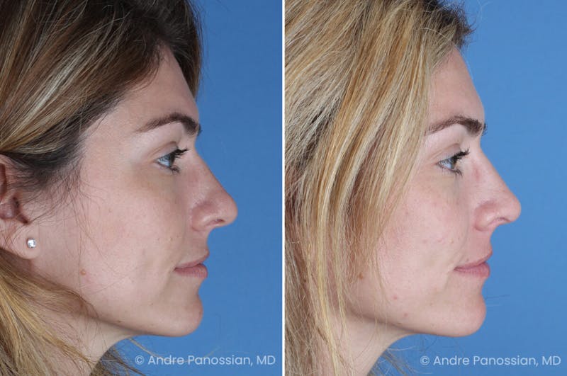Rhinoplasty Before & After Gallery - Patient 303679 - Image 1