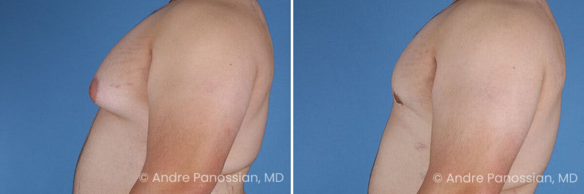 Male Breast Reduction (Gynecomastia) Before & After Gallery - Patient 419668 - Image 5