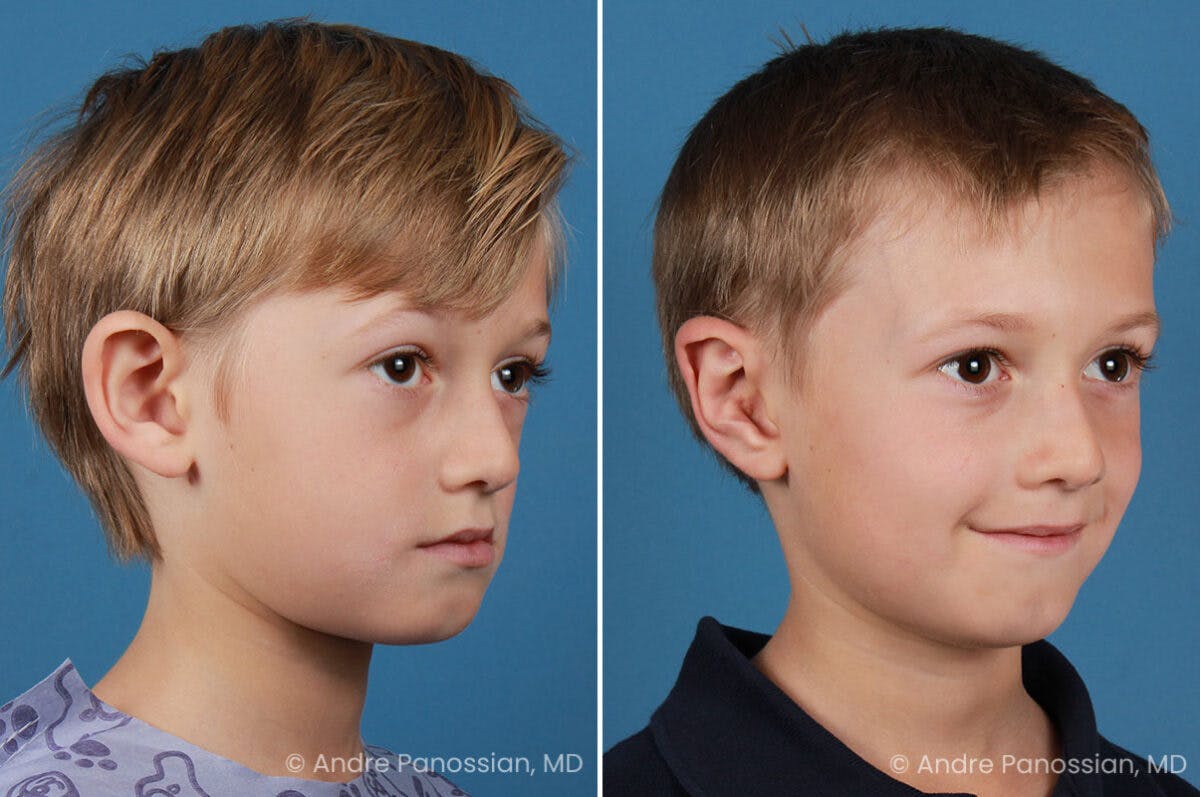 Ear Pinning (Otoplasty) Before & After Gallery - Patient 218645 - Image 2